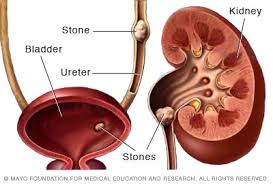 Kidneystone treatment in West Delhi